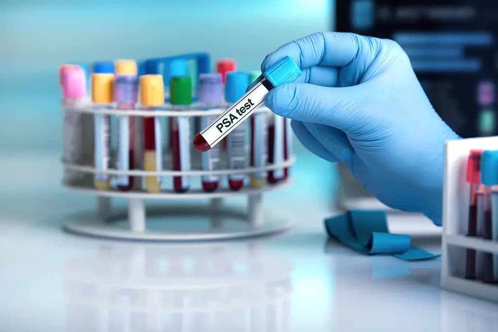 Complete Guide to the Prostate Cancer Test: PSA Explained