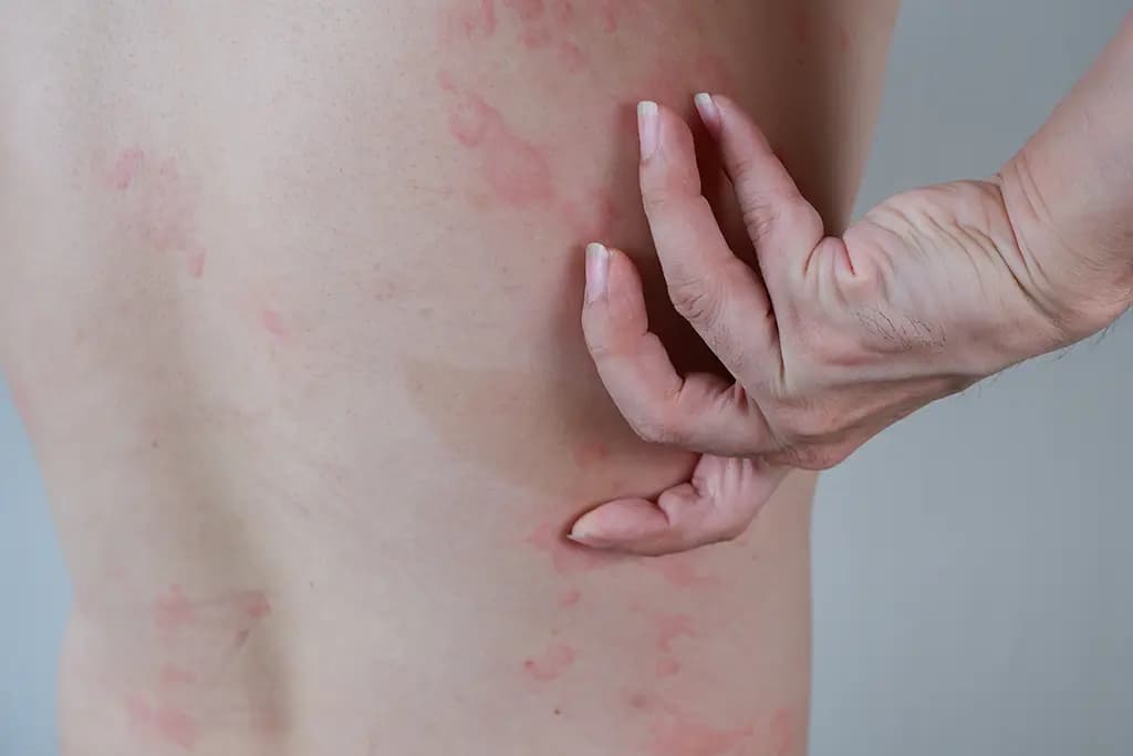 What are the Initial Symptoms of HIV