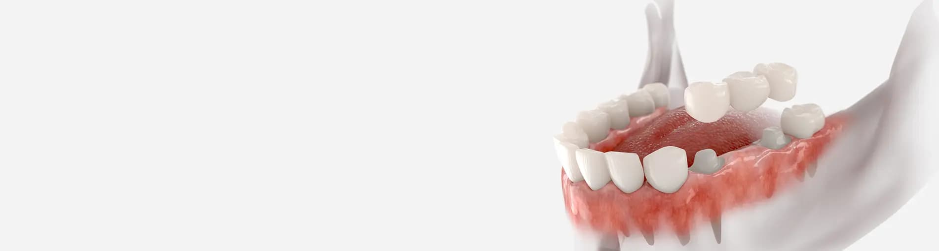Dental Crowns