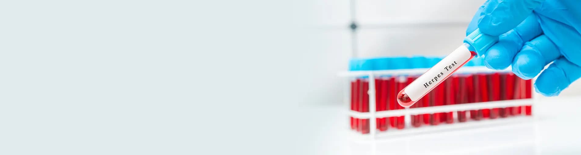 Herpes Testing