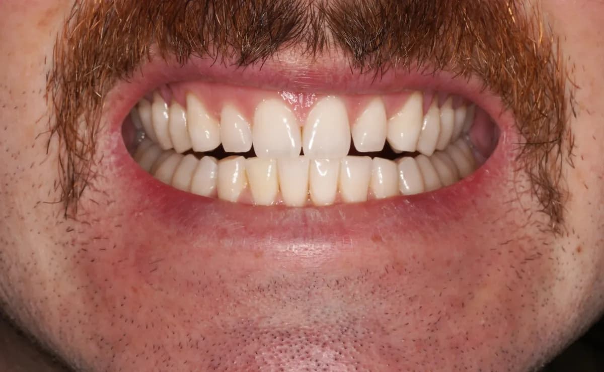 After Teeth Whitening