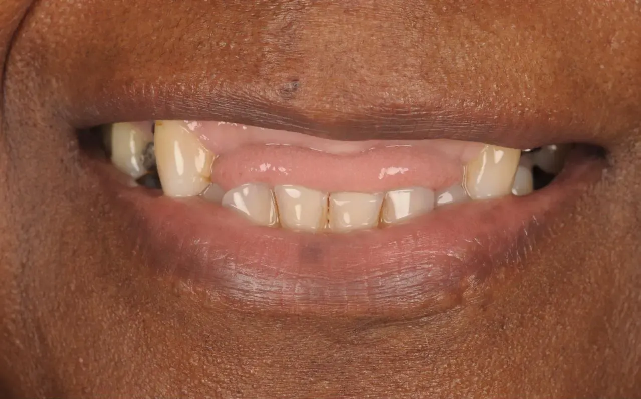 Before Tooth Implants