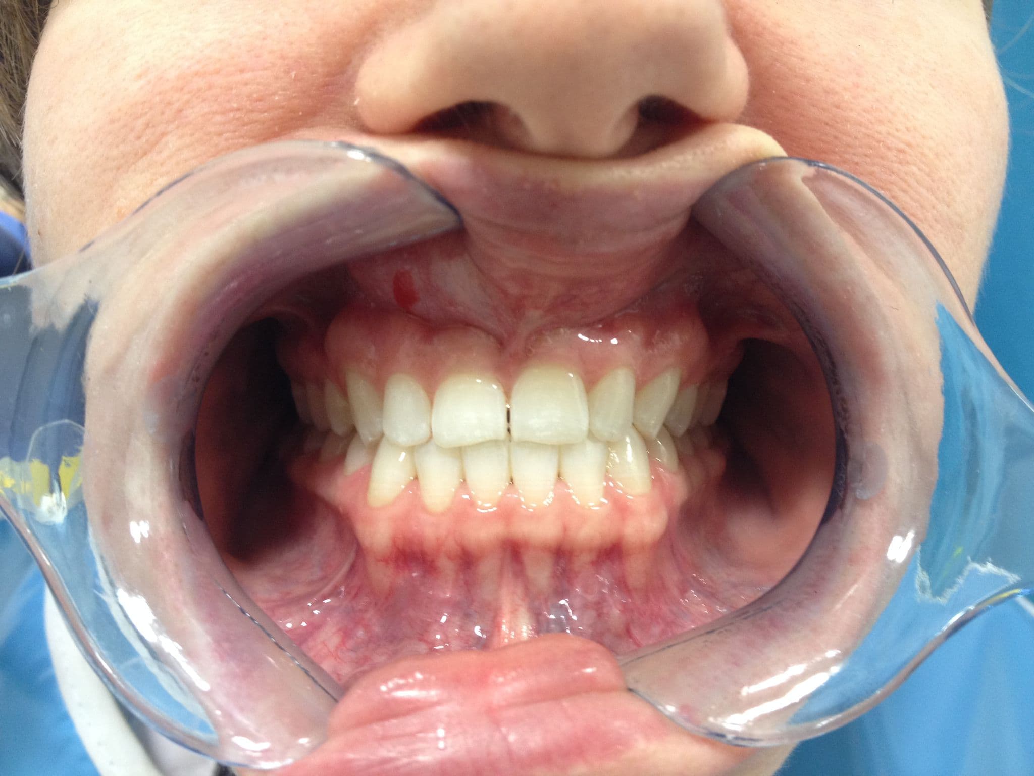 Before Porcelain Veneers