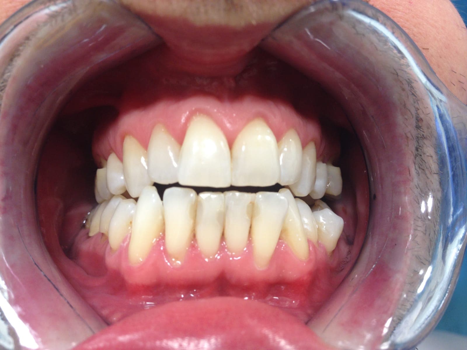 After Home Teeth Whitening