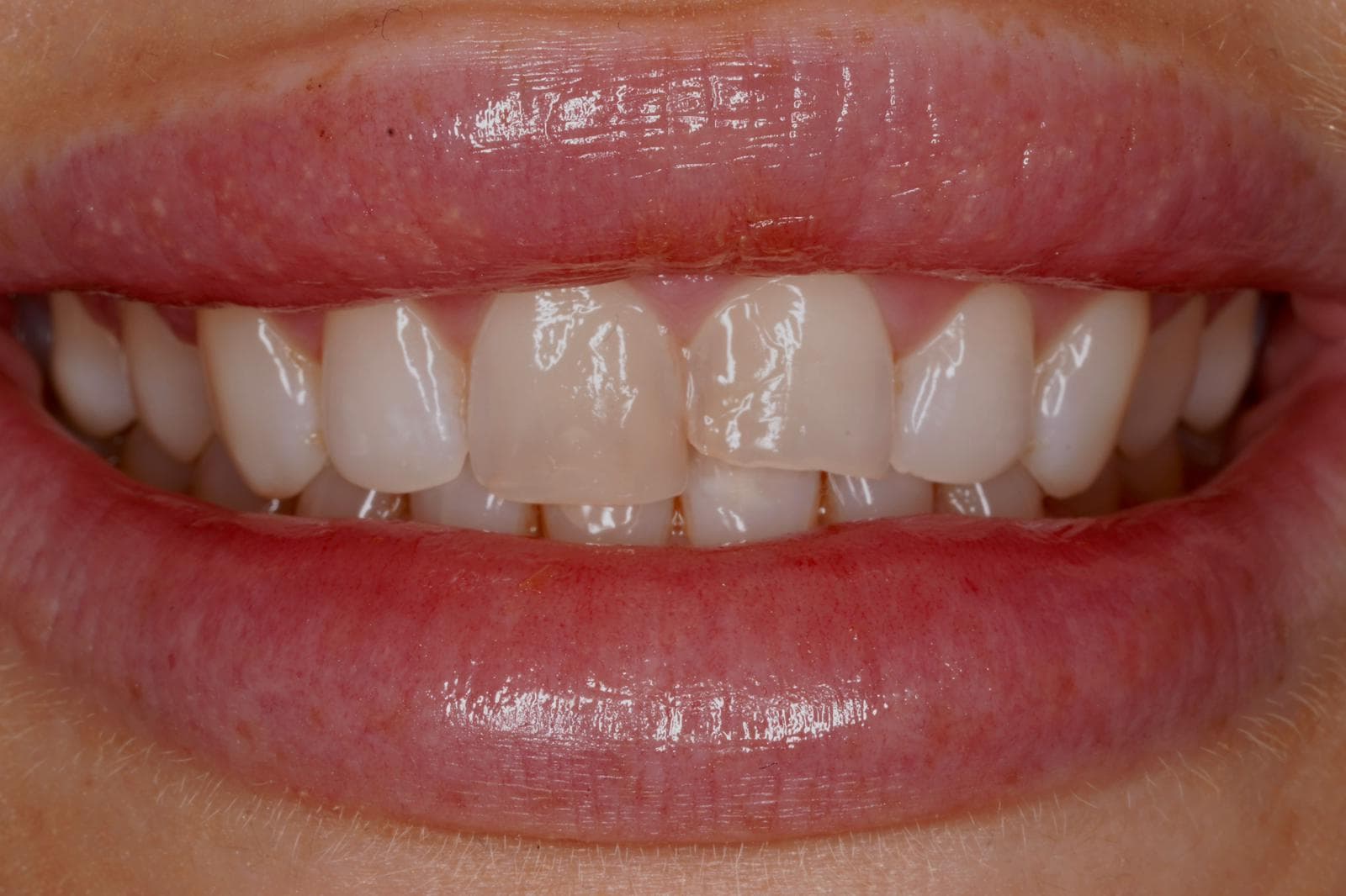 Before Composite Bonding