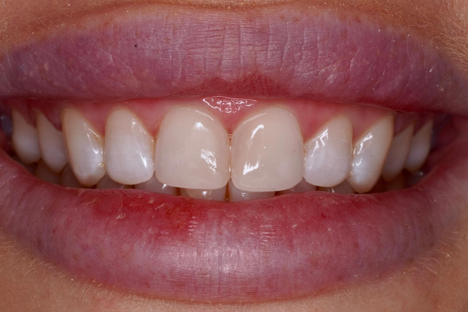 After Composite Bonding