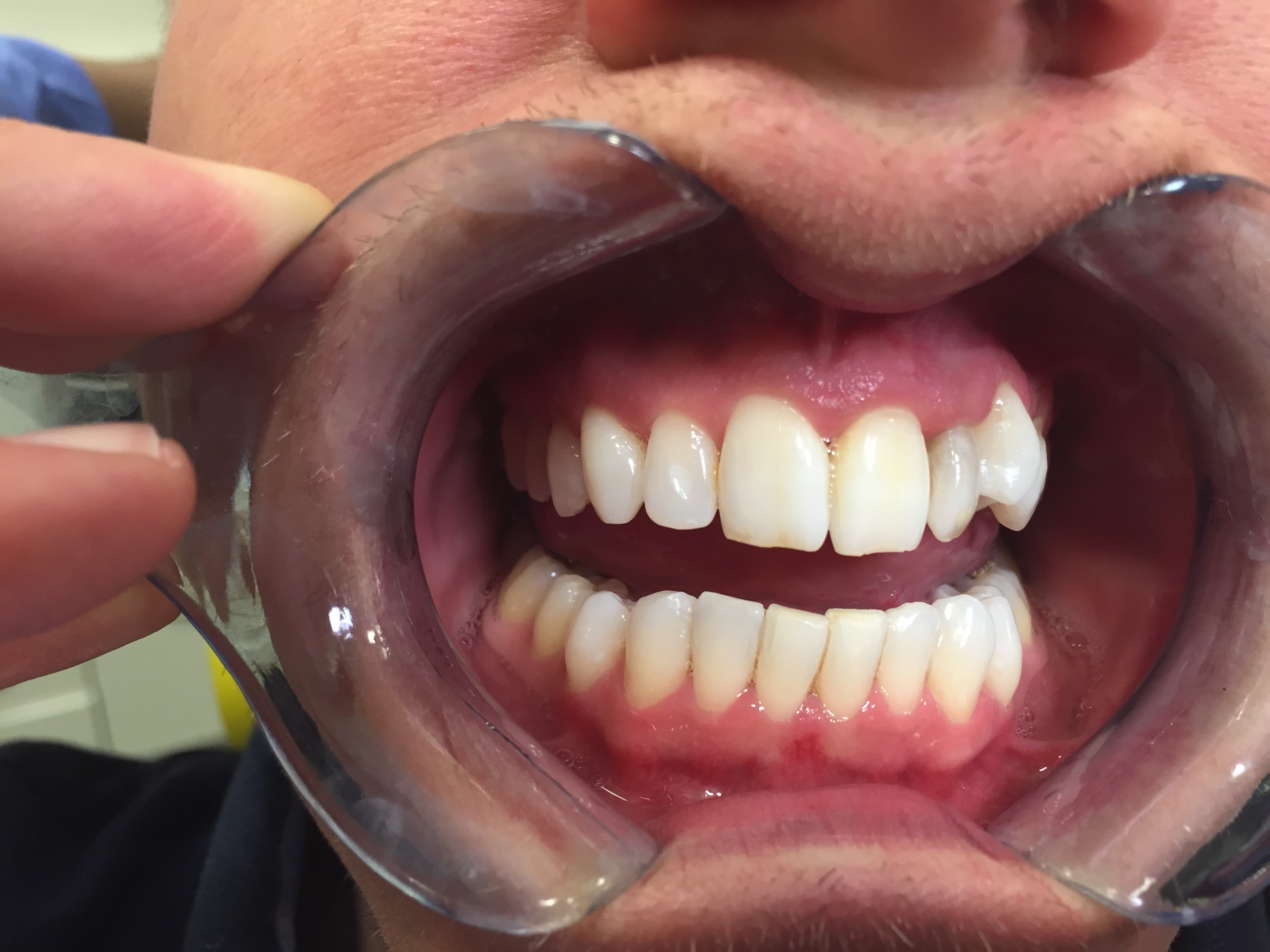 After Teeth Whitening