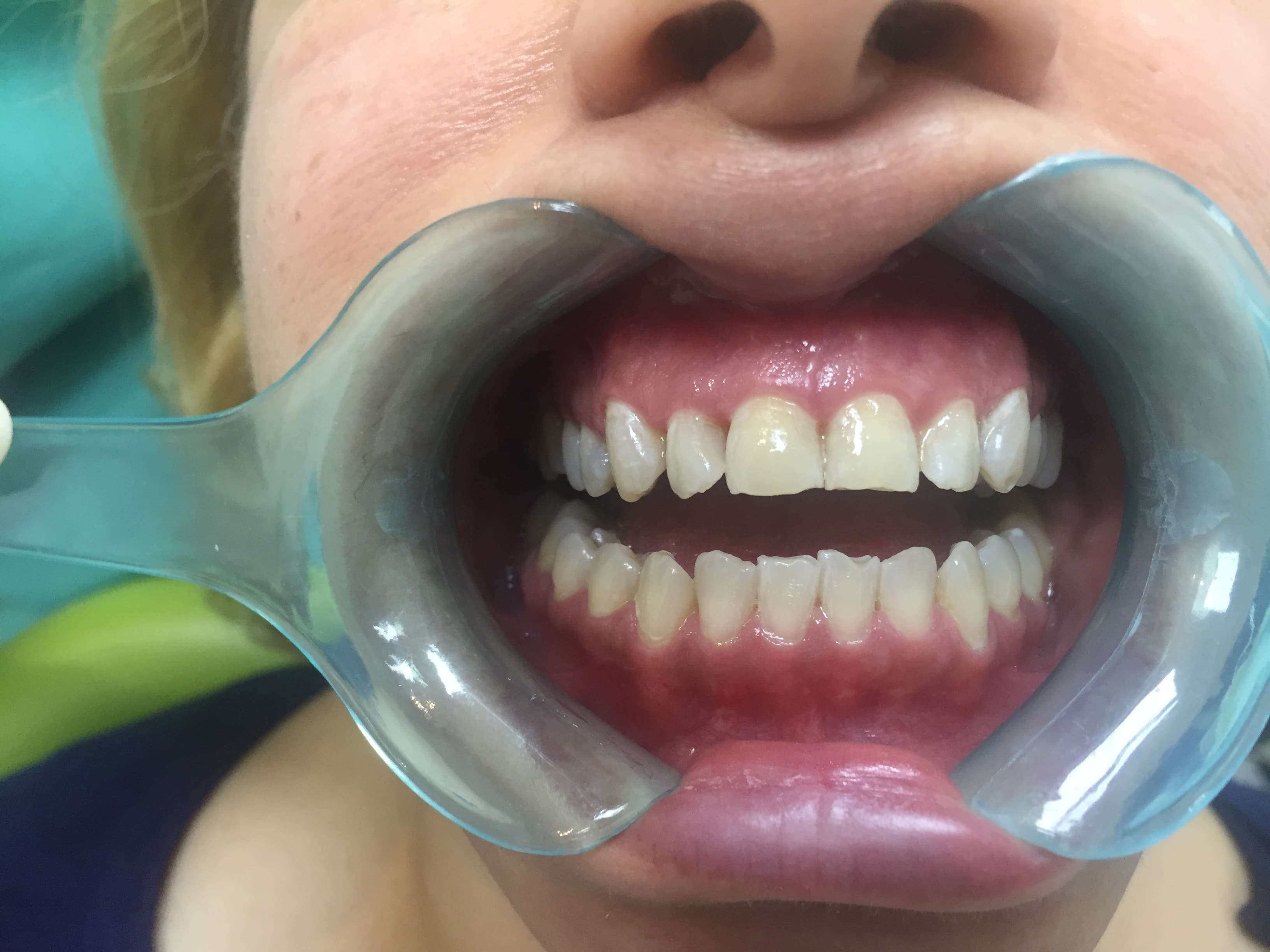 After Composite Bonding
